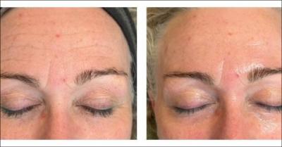 Japansk Bio Micro Needling Peeling med markant hudforbedring