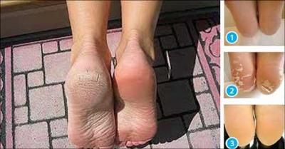 Bestseller: 1 sæt fodpleje-poser