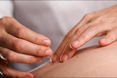 60 minutters akupunktur