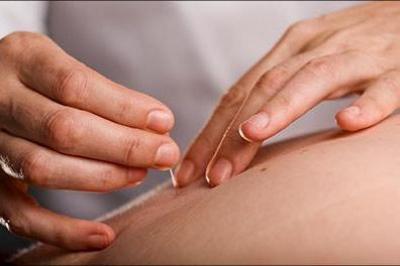 Bestseller: Akupunkturbehandling - til rygestop